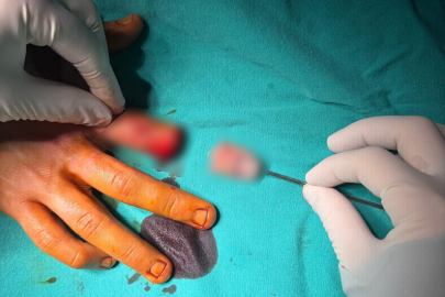 KOPAN PARMAK MİKROCERRAHİYLE YENİDEN DİKİLDİ